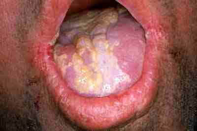 Candida1.jpg