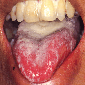 Yeast-infections-in-menSymptoms-of-Oral-Candida.png
