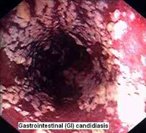candidacleansegastrocandidia.jpg