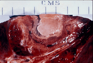 Aspergilloma.png