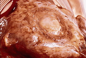 Aspergilloma2.png
