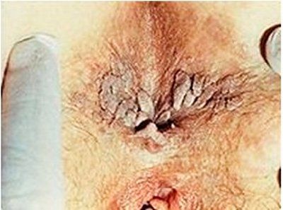 warts.jpg