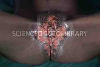 M1120288-Genital_herpes_in_female_AIDS_patient-SPL.jpg