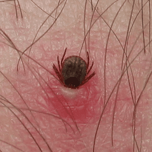 tick-human-.png