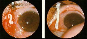 tapeworm-larvae-eye.jpg