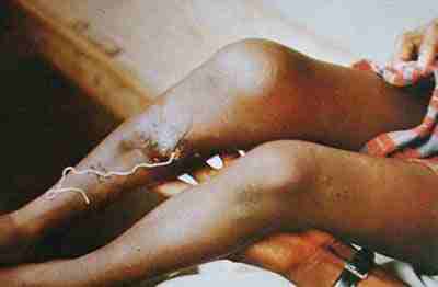 guinea-worm.jpg
