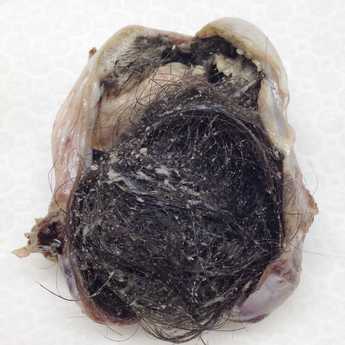 teratoma1.jpg