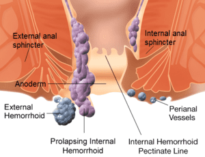 WikipediaInternalAndExternalHemorrhoids300x250.png