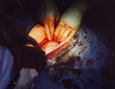 cyst1.jpg