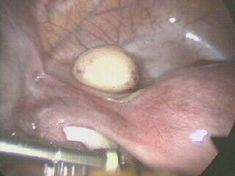 dermoidcyst1.jpg