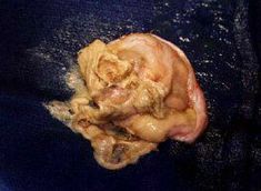 dermoidcyst2.jpg