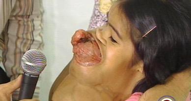 080422_Vietnamese_girl_tumor.jpg