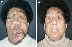 080821-face-transplant-bcol2p_standard.jpg