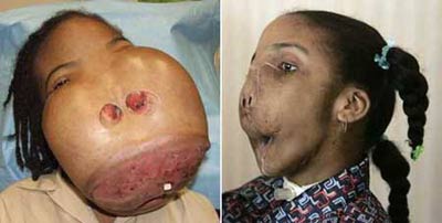 little_girls_face_tumor.jpg