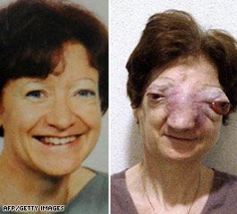 t1home_tumor_thurs_07_afp.jpg