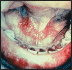 a_oral_cancer.jpg