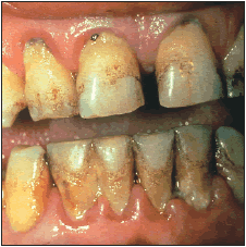 periodontitis.gif