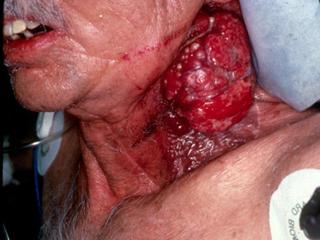tumor-neck-smoking.jpg