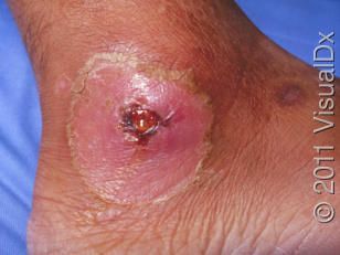 diptheria%20cutaneous.jpg