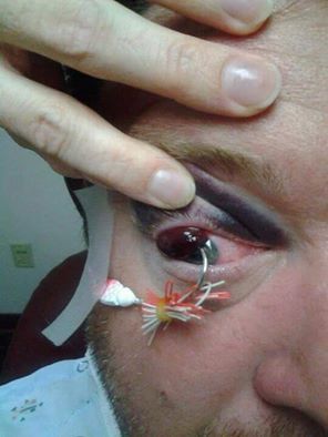 fishhook%20in%20eye.jpg