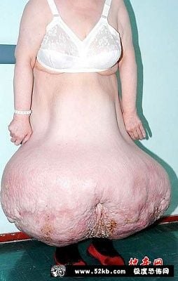 overweight.jpg