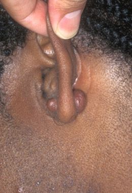 ear%20keloids.jpg
