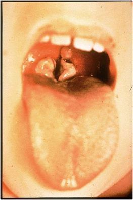 dptheria%20mouth.jpg