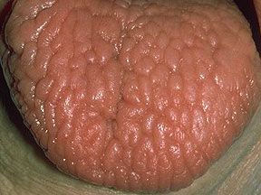 tongue-fissured.jpg