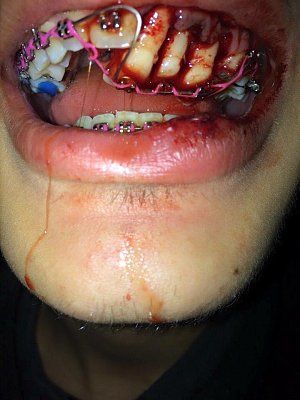 teeth-20knocked-20in-20with-20braces.jpg