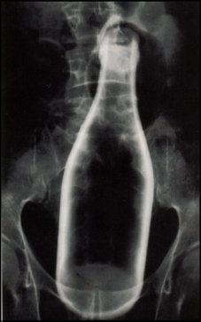 charonboat_dot_com_foreign_body_vagina.jpg