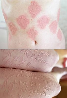 a358_dermatographia.jpg