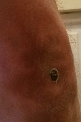 acegoober_burnt_knee.jpg