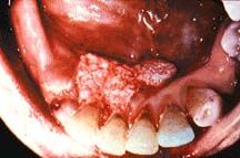 mouthcancer_2.jpg
