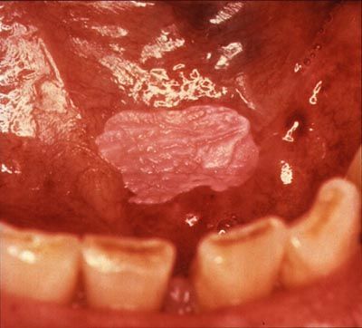 mouthcancer_3.jpg