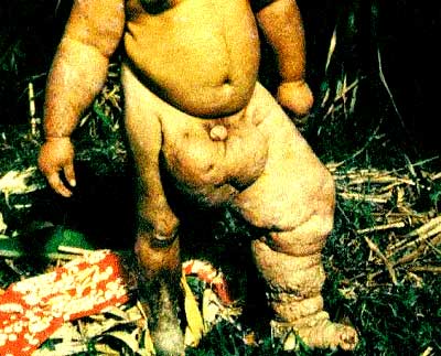 elephantiasis2.jpg