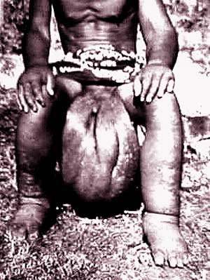 Elephantiasis6.jpg