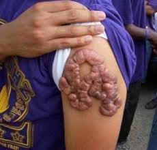 scarification%20damage.jpeg