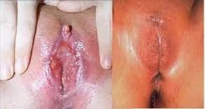 FGMinAmerica-Before%26AfterFGM.jpg