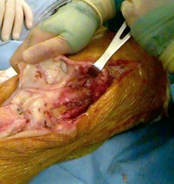 knee4_pwm.jpg