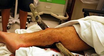 bad_20injury02.jpg