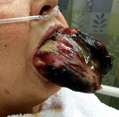liveleak-dot-com-tonguebittenbyspider1_1522651115.jpg