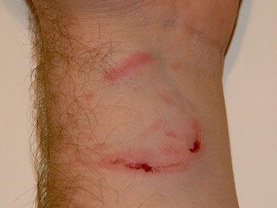 Name:  bite_mark.jpg
Views: 793
Size:  18.0 KB