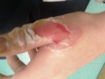 drews-finger-2.jpg