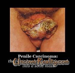 penile_cancer_small.jpg