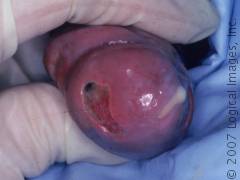 primaryInfectionGonorrhea_12445_med.jpg