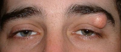 sebaceouscystlid.jpg