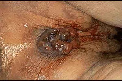 prolapsed_hemorrhoids.jpg