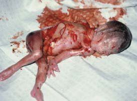 partial birth abortion.jpg