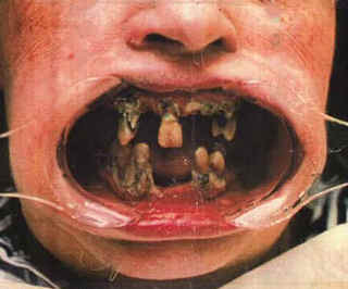 bad-teeth.jpg