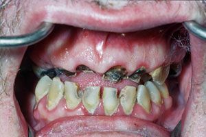 meth-mouth_000.jpg